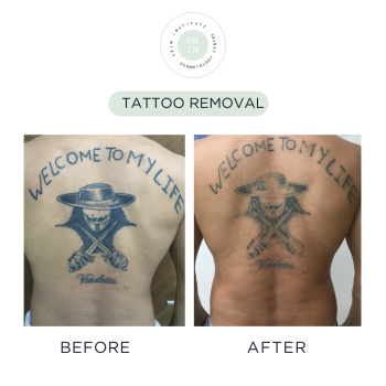 skin clinic abu dhabi  | Tattoo removal | best dermatologist in abu dhabi