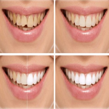 Best Cosmetic bonding treatment in Dubai UAE