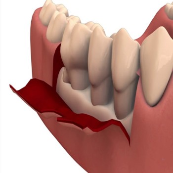 Best Dental flap surgery treatment in Dubai UAE