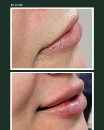 Lips treatment and augmentation using the cannula technique is indeed one of the best options fo
