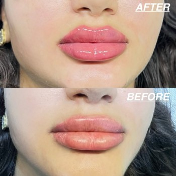 Enhance your natural beauty with our Lip filler treatment __ @drarzhangjavadi DM us or call - 